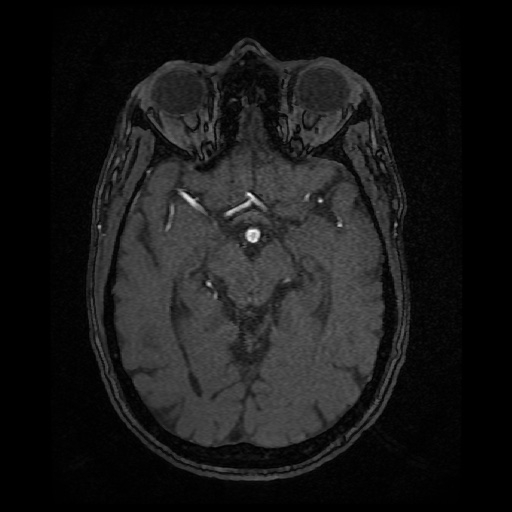 Basilar top and left middle cerebral artery aneurysm (Radiopaedia 61965-70031 Axial MRA 68).jpg