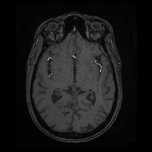 Basilar top and left middle cerebral artery aneurysm (Radiopaedia 61965-70031 Axial MRA 78).jpg