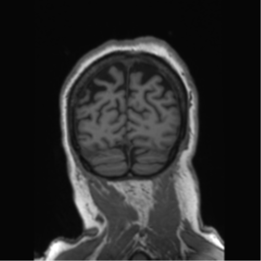 File:Behavioral variant frontotemporal dementia and late onset schizophrenia (Radiopaedia 52197-58083 Coronal T1 22).png