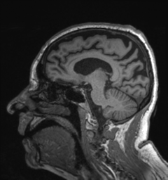 Behavioral variant frontotemporal dementia and late onset schizophrenia (Radiopaedia 52197-58083 Sagittal T1 40).png