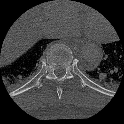 Benign post-traumatic pseudopneumoperitoneum (Radiopaedia 71199-81495 Axial bone window 129).jpg