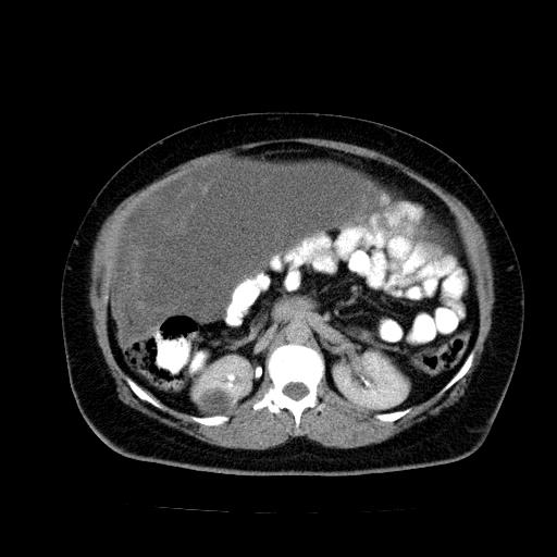 Benign spindle cell tumor - abdominopelvic (Radiopaedia 61300-69212 Axial C+ delayed 25).jpg