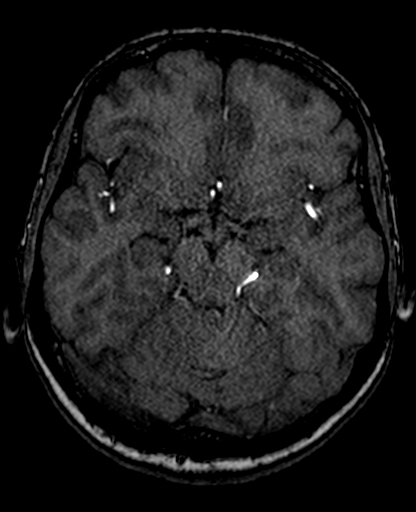File:Berry aneurysm of the terminal internal carotid artery (Radiopaedia 88286-104918 Axial TOF 105).jpg
