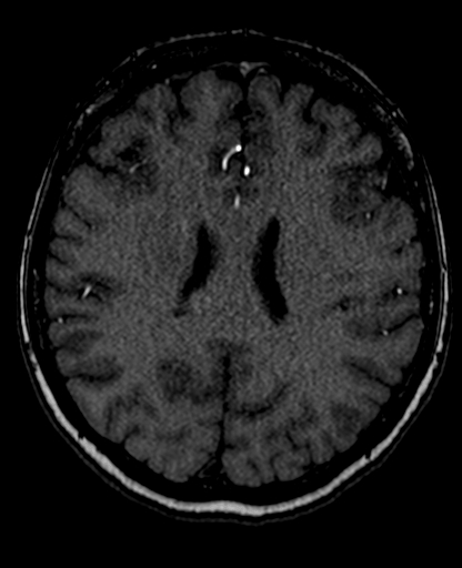Berry aneurysm of the terminal internal carotid artery (Radiopaedia 88286-104918 Axial TOF 152).jpg