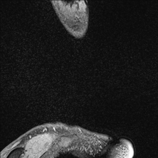 Bilateral Achilles tendon complete tear (Radiopaedia 81344-95051 Sagittal WE - Left 15).jpg