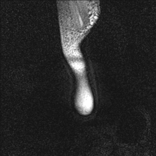 Bilateral Achilles tendon complete tear (Radiopaedia 81344-95051 Sagittal WE - Right 5).jpg