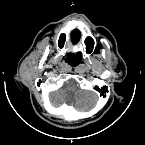 Bilateral Warthin tumors (Radiopaedia 84034-99263 Axial With contrast 14).jpg