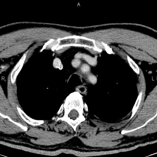Bilateral Warthin tumors (Radiopaedia 84034-99263 Axial With contrast 73).jpg