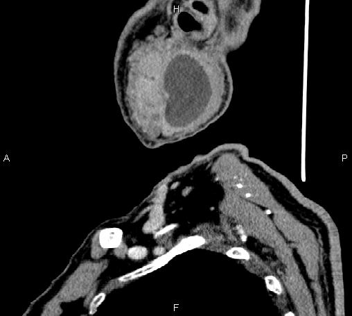 Bilateral Warthin tumors (Radiopaedia 84034-99263 D 18).jpg