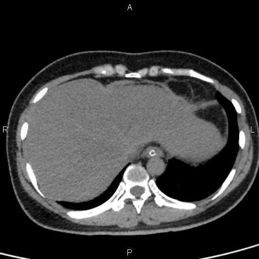 Bilateral adrenal gland hyperenhancement in pancreatitis (Radiopaedia 86642-102753 Axial non-contrast 12).jpg