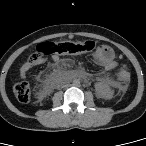 File:Bilateral adrenal gland hyperenhancement in pancreatitis (Radiopaedia 86642-102753 Axial non-contrast 61).jpg