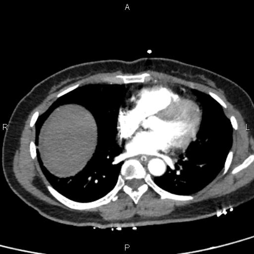 Bilateral adrenal gland hyperenhancement in pancreatitis (Radiopaedia 86642-102753 B 3).jpg