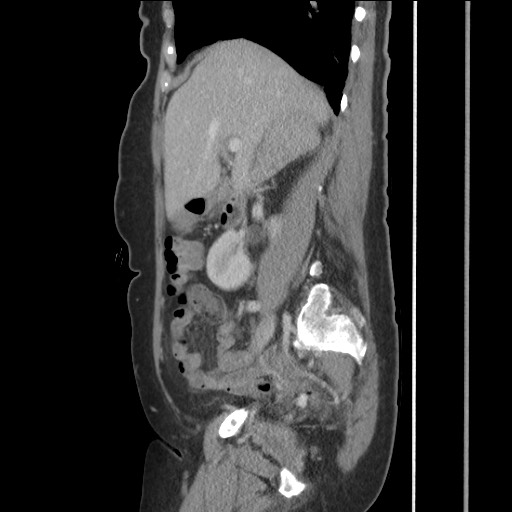Bilateral adrenal granulocytic sarcomas (chloromas) (Radiopaedia 78375-91007 C 56).jpg