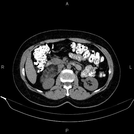 Bilateral adrenal myelolipoma (Radiopaedia 63058-71535 Axial non-contrast 70).jpg
