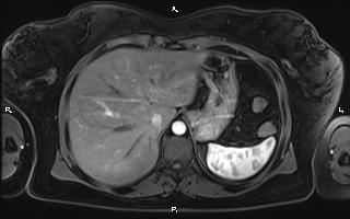 Bilateral adrenal myelolipoma (Radiopaedia 63058-71537 Axial T1 C+ fat sat 22).jpg