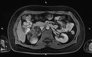 File:Bilateral adrenal myelolipoma (Radiopaedia 63058-71537 H 45).jpg
