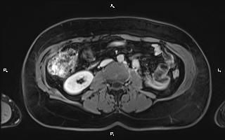File:Bilateral adrenal myelolipoma (Radiopaedia 63058-71537 H 61).jpg