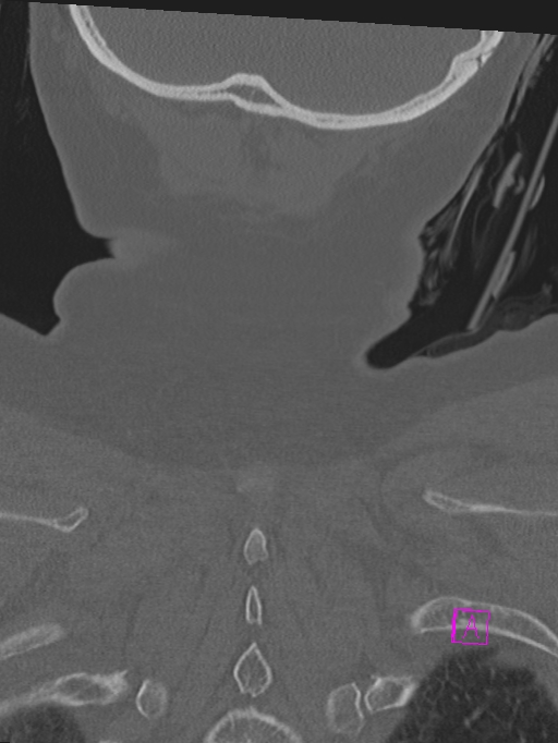 Bilateral atlanto-occipital assimilation (Radiopaedia 28350-28603 Coronal bone window 51).jpg