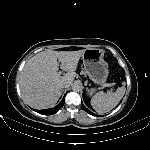 File:Bilateral benign adrenal adenomas (Radiopaedia 86912-103124 Axial C+ delayed 21).jpg