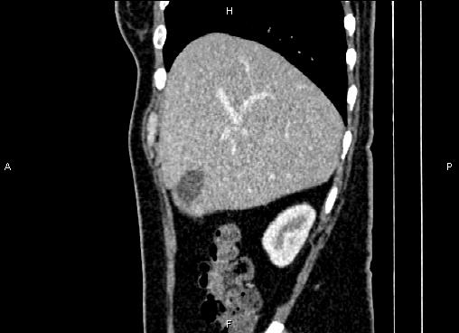 Bilateral benign adrenal adenomas (Radiopaedia 86912-103124 E 19).jpg