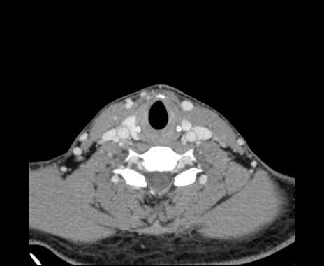 Bilateral carotid body tumors (Radiopaedia 61841-69870 Axial Post contrast 81).jpg