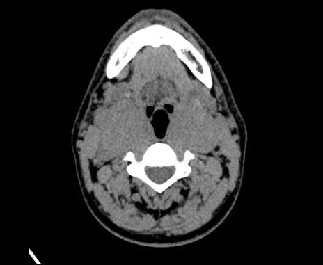 Bilateral carotid body tumors (Radiopaedia 61841-69870 Axial non-contrast 47).jpg