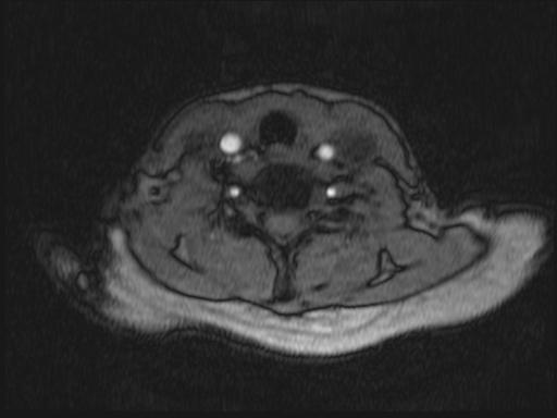Bilateral carotid body tumors and right glomus jugulare tumor (Radiopaedia 20024-20060 Axial MRA 211).jpg