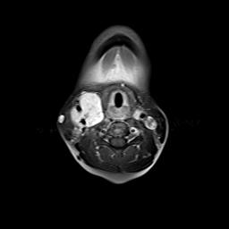 File:Bilateral carotid body tumors and right jugular paraganglioma (Radiopaedia 20024-20060 Axial 92).jpg