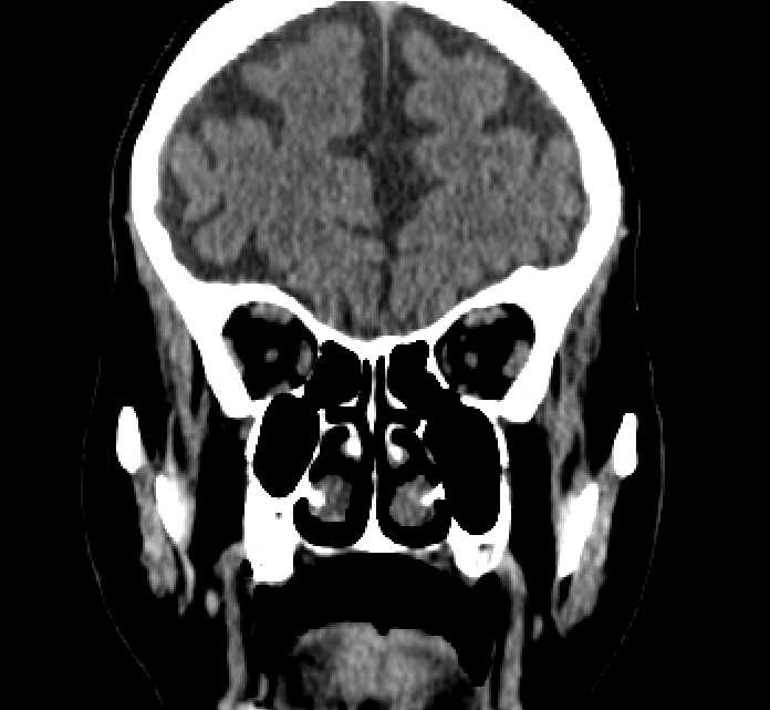 Bilateral ectopia lentis (Radiopaedia 89889-107013 Coronal non-contrast 77).jpg