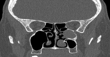 File:Bilateral ectopic infraorbital nerves (Radiopaedia 49006-54084 Coronal 18).png
