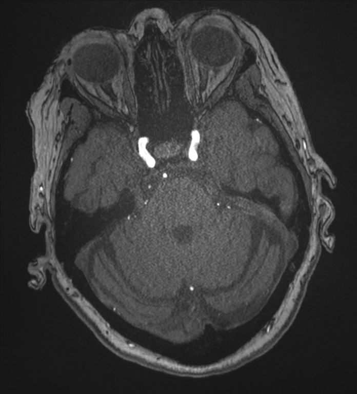 Bilateral fetal posterior communicating arteries (Radiopaedia 41286-44102 Axial MRA 56).png