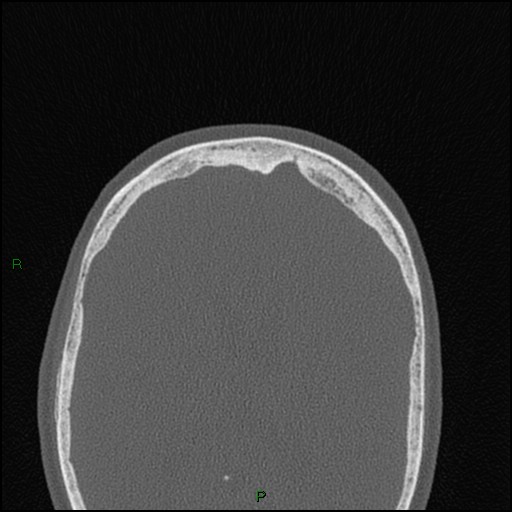 Bilateral frontal mucoceles (Radiopaedia 82352-96454 Axial bone window 48).jpg