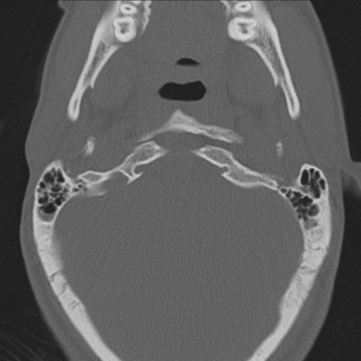Bilateral locked facets (Radiopaedia 33850-35016 Axial bone window 2).png