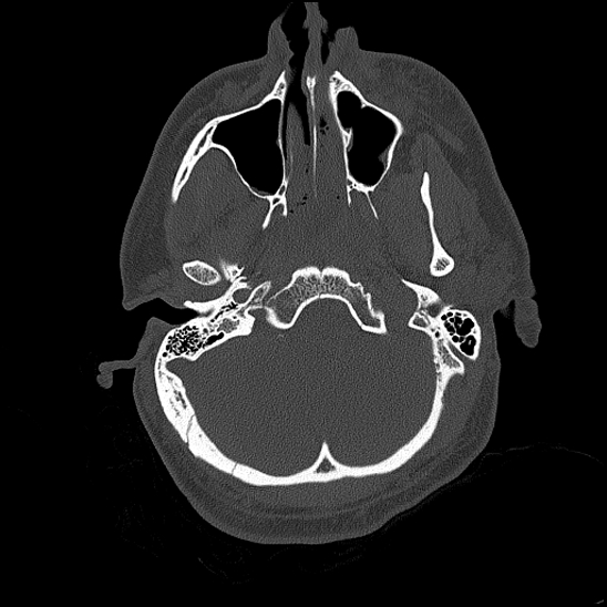 Bilateral occipital condyle fracture (type 2) (Radiopaedia 87675-104089 Axial bone thins 41).jpg