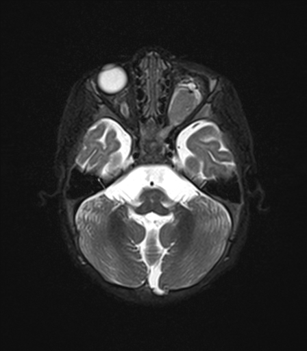 File:Bilateral optic pathway gliomas (Radiopaedia 40013-42514 Axial T2 fat sat 3).jpg