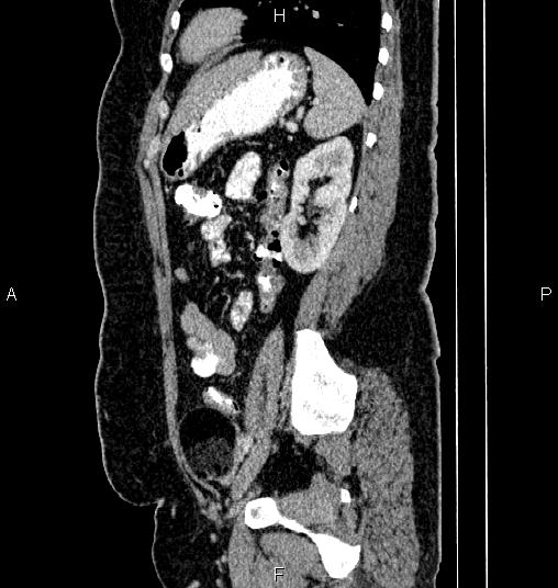 File:Bilateral ovarian dermoid cysts (Radiopaedia 85785-101603 D 68).jpg