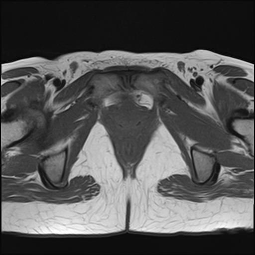 File:Bilateral ovarian endometriomas (Radiopaedia 87085-103347 Axial T1 20).jpg