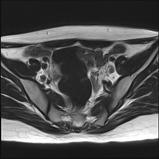 File:Bilateral ovarian endometriomas (Radiopaedia 87085-103347 Axial T2 7).jpg