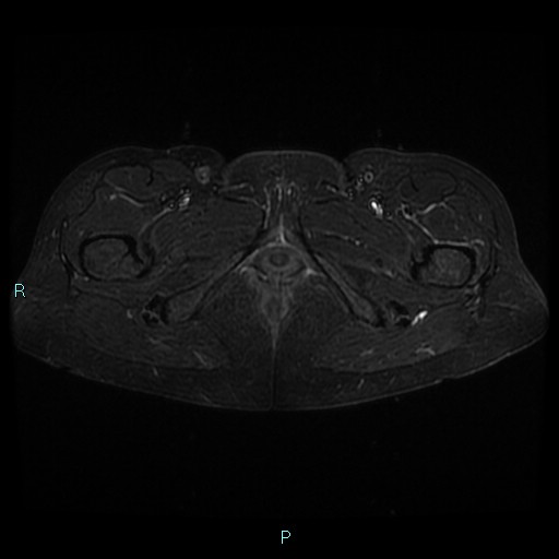 File:Bilateral ovarian fibroma (Radiopaedia 44568-48293 Axial STIR 30).jpg