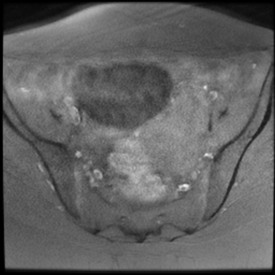 File:Bilateral ovarian fibrothecomas - adolescent (Radiopaedia 86604-102707 Axial T1 fat sat 13).jpg