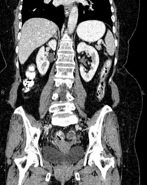 Bilateral ovarian serous cystadenocarcinoma (Radiopaedia 86062-101989 D 31).jpg