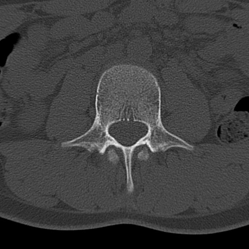 File:Bilateral pars defect (Radiopaedia 26691-26846 Axial bone window 1).jpg
