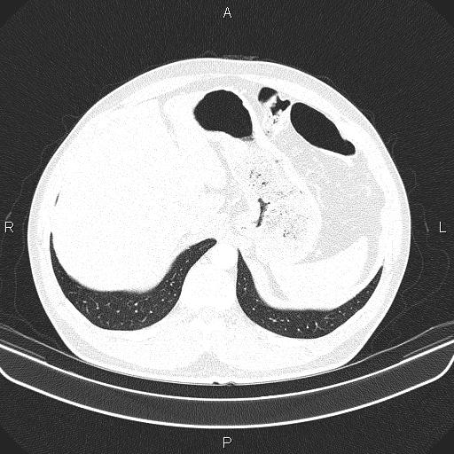 File:Bilateral pulmonary AVM (Radiopaedia 83134-97505 Axial lung window 69).jpg