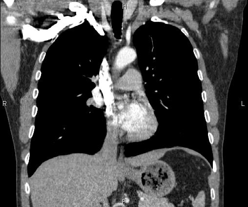 File:Bilateral pulmonary AVM (Radiopaedia 83134-97505 C 36).jpg