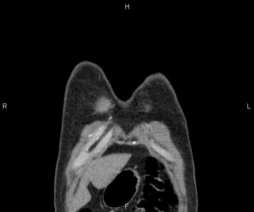 Bilateral pulmonary AVM (Radiopaedia 83134-97505 C 5).jpg