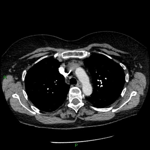 Bilateral pulmonary emboli (Radiopaedia 32700-33669 Axial C+ CTPA 34).jpg