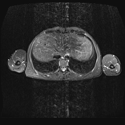 File:Bilateral spinoglenoid notch ganglion cysts (Radiopaedia 29577-30082 E 29).jpg