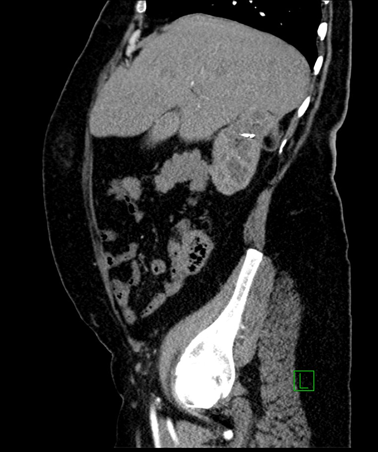 Bilateral sporadic synchronous clear cell renal cell carcinoma (Radiopaedia 85035-100575 E 91).jpg