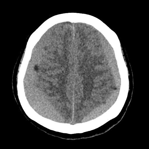 Bilateral subacute subdural hematoma (Radiopaedia 69240-79018 Axial non-contrast 37).jpg