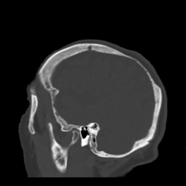 Biparietal osteodystrophy (Radiopaedia 46109-50463 Sagittal bone window 24).jpg